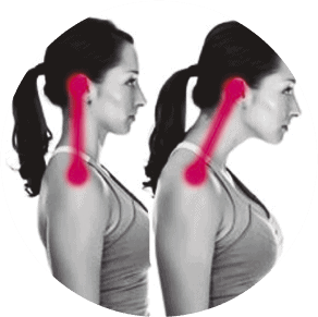 cabeca anteriorizada