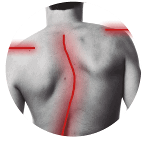 escoliose e dores coluna